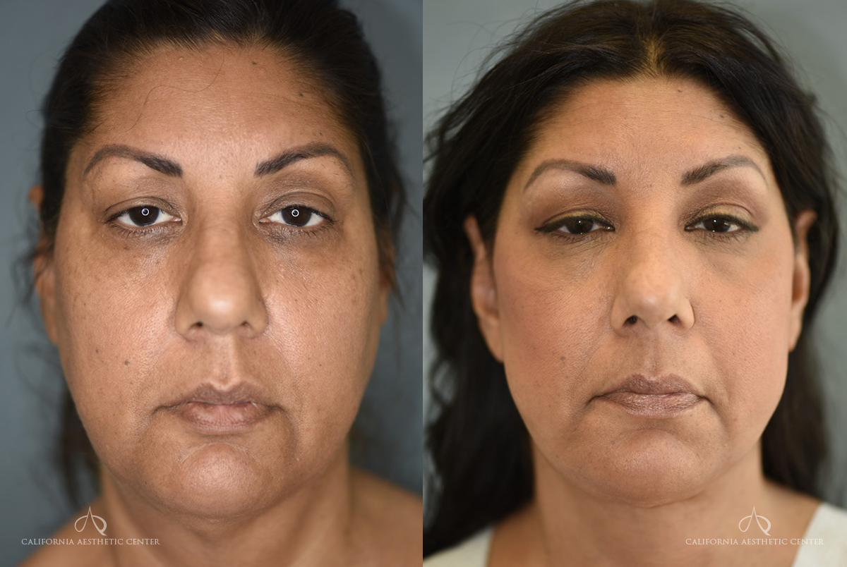 Patient 2 Face Lift Before and After Front View