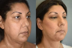 Patient 2 Face Lift Before and After Right Oblique View
