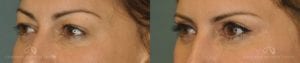 Patient 1 Blepharoplasty Before and After Left Oblique View