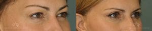 Patient 1 Blepharoplasty Before and After Right Oblique View
