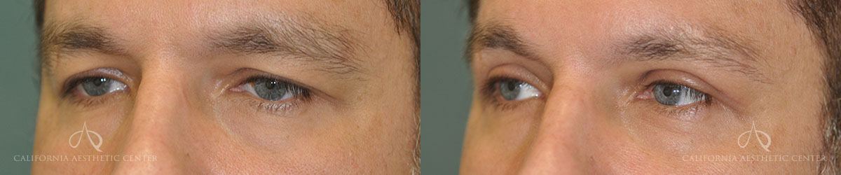 Patient 2 Blepharoplasty Before and After Left Oblique View