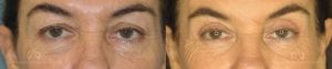 Patient 3 Blepharoplasty Before and After Front View