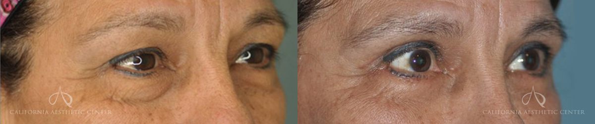 Patient 4 Blepharoplasty Before and After Right Oblique View