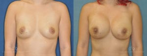 Patient 6 Breast Augmentation Before and After Front View