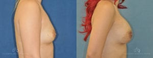 Patient 6 Breast Augmentation Before and After Right Side View