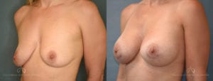Patient 8 Breast Augmentation Before and After Left Oblique View
