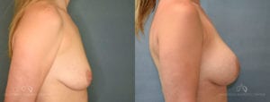 Patient 8 Breast Augmentation Before and After Right Side View