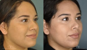 Patient 1 Rhinoplasty Before and After Right Angle View