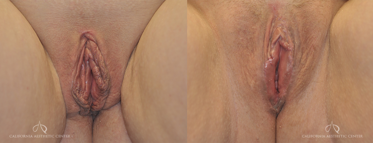 Patient 1a Labiaplasty Before and After