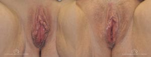 Patient 1b Labiaplasty Before and After