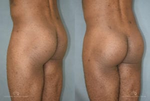 Patient 1 Brazilian Butt Lift Before and After Back Left Oblique View