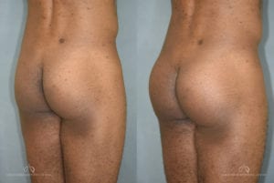 Patient 1 Brazilian Butt Lift Before and After Back Right Oblique View