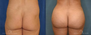 Patient 1 Brazilian Butt Lift Before and After Back View